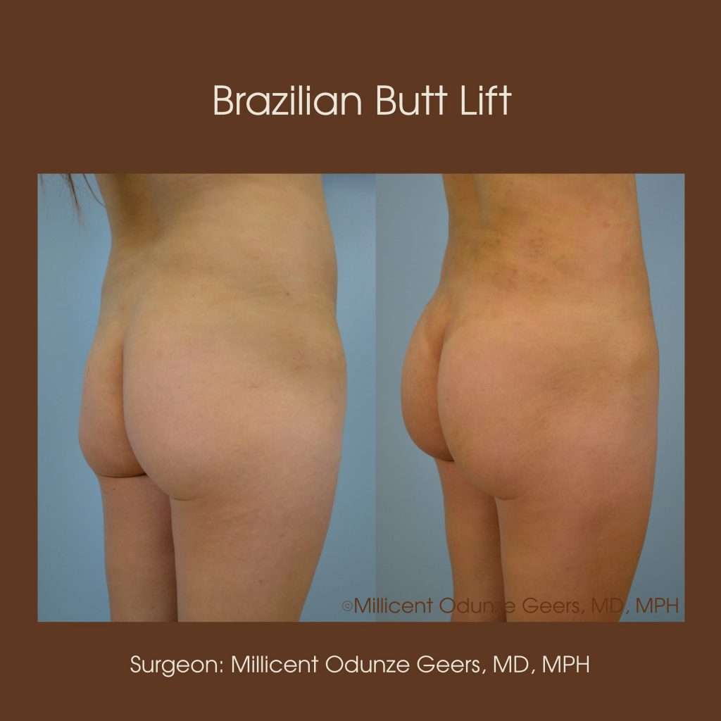 Brazilian Butt Lift -Flying Horse Medical Center - Dr. Millicent Odunze Geers