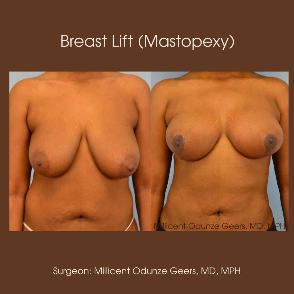 Breast Lift - Mastopexy - Plastic Surgery at Flying Horse Medical Center - Dr. Millicent Odunze Geers