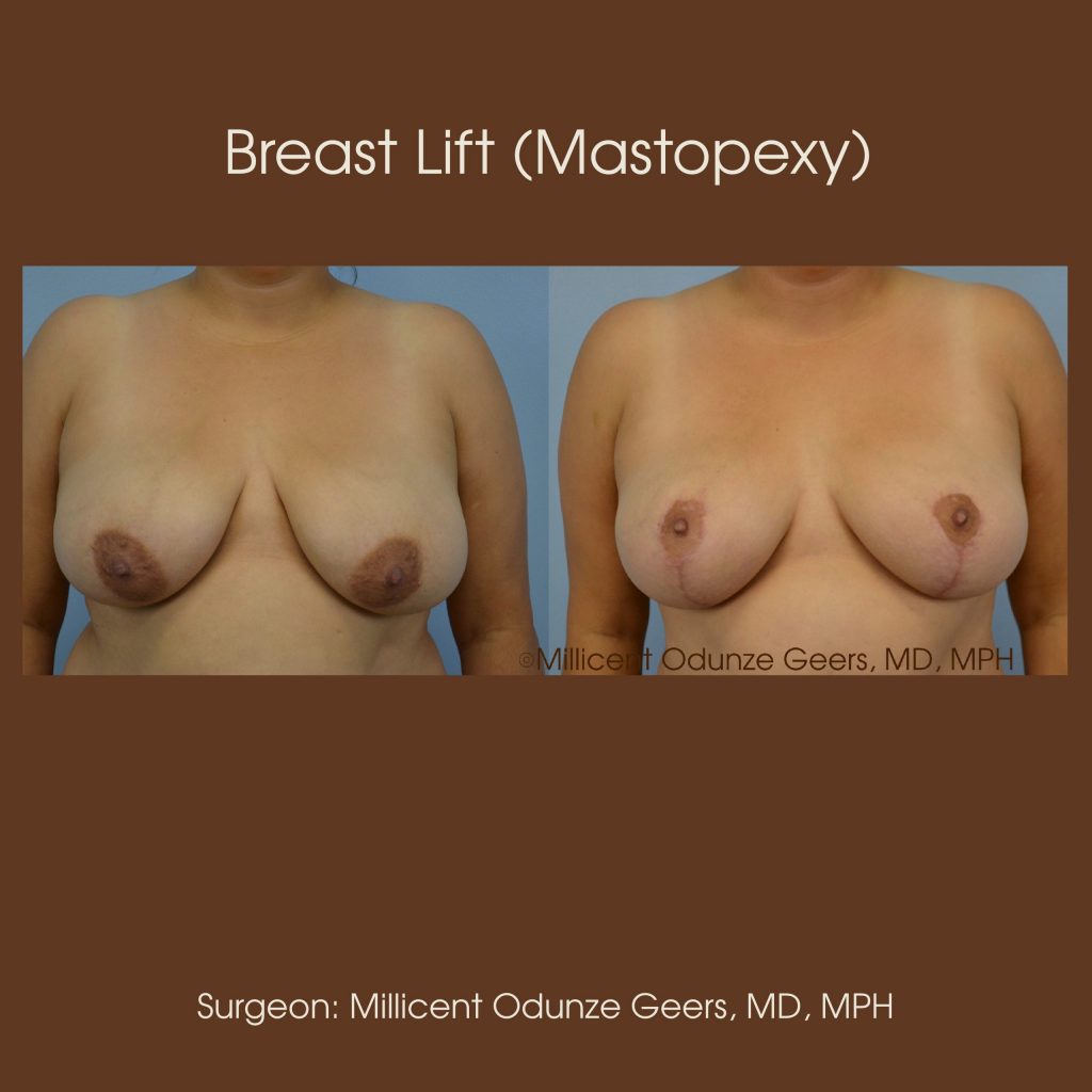 Breast Lift - Mastopexy - Plastic Surgery at Flying Horse Medical Center - Dr. Millicent Odunze Geers