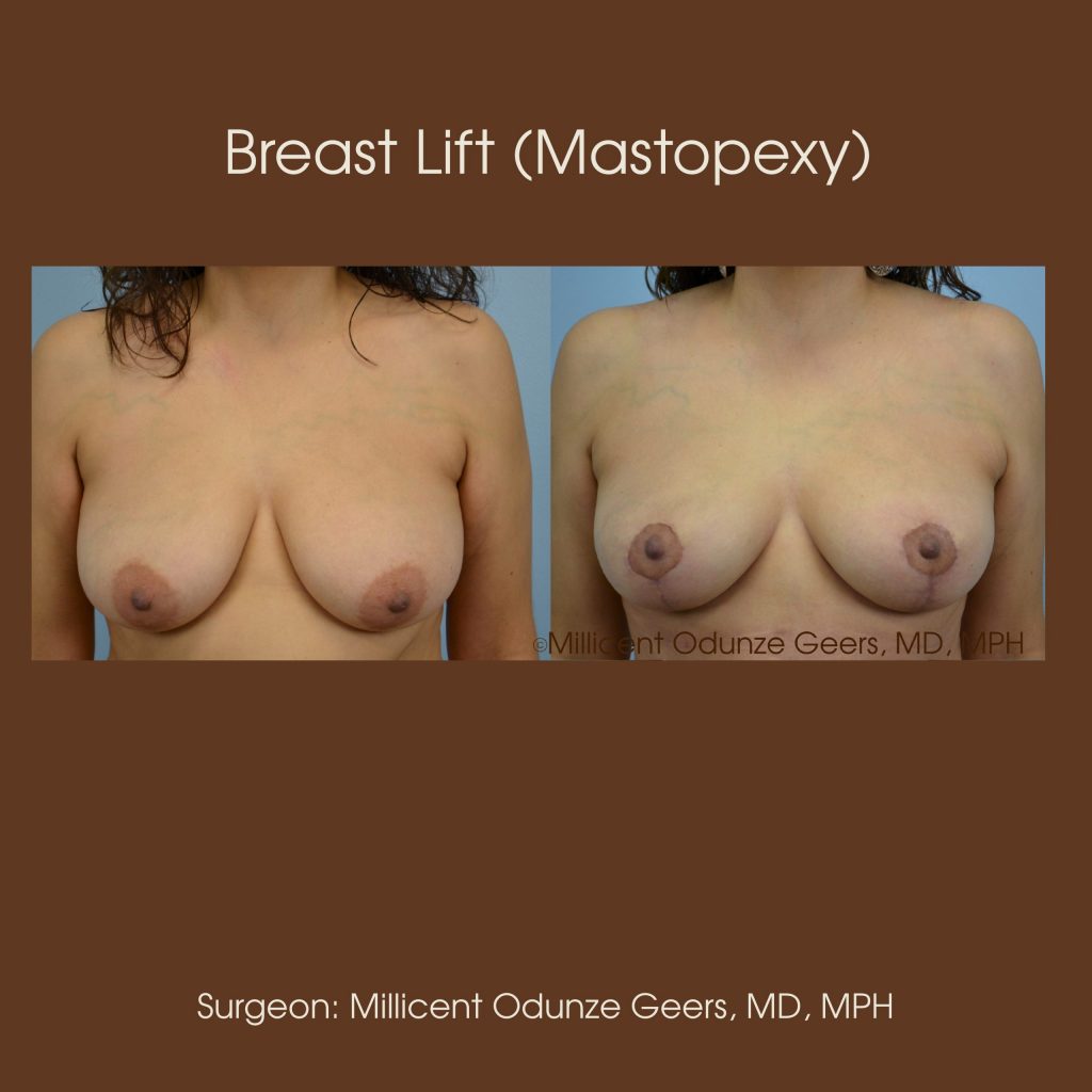 Breast Lift - Mastopexy - Plastic Surgery at Flying Horse Medical Center - Dr. Millicent Odunze Geers