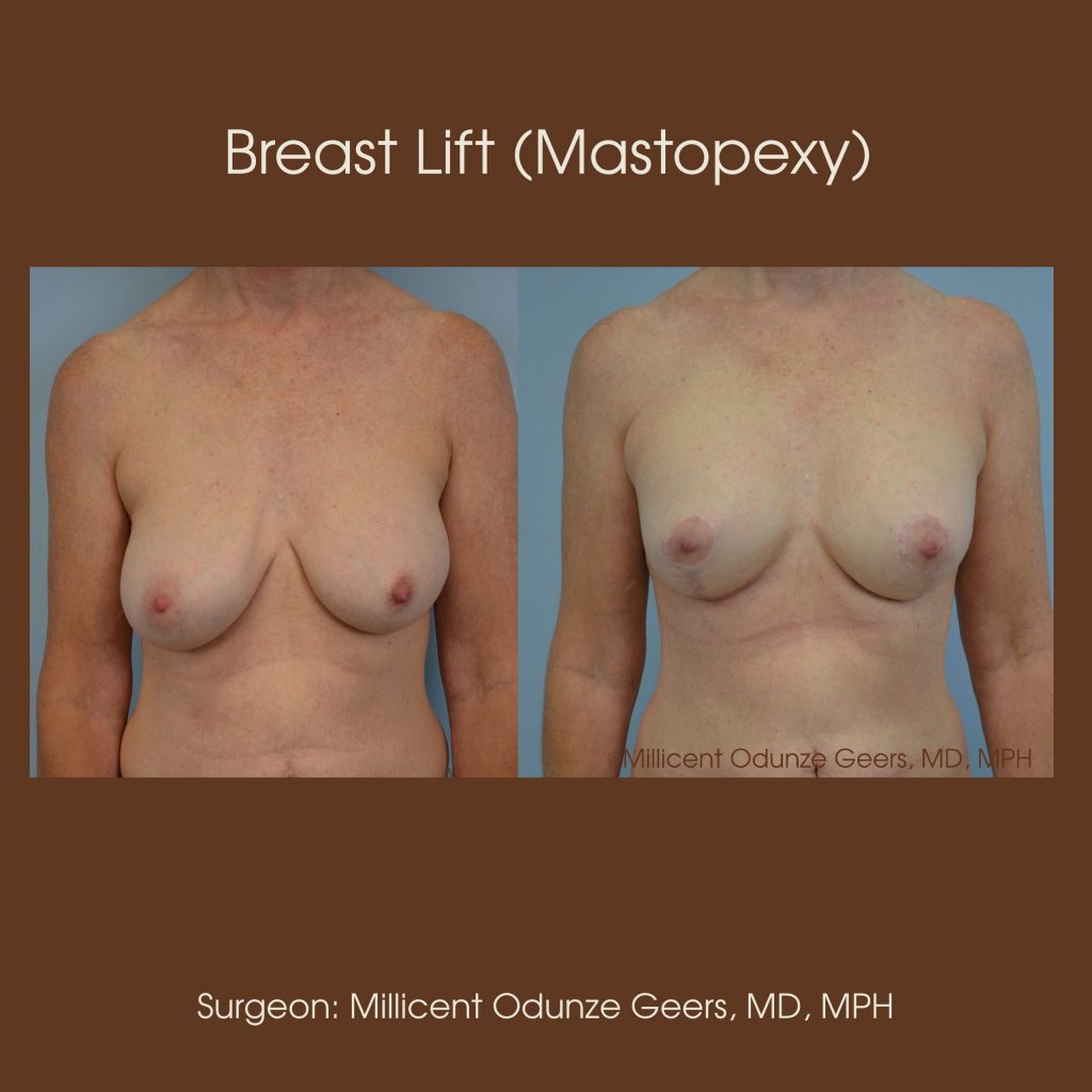 Breast Lift - Mastopexy - Plastic Surgery at Flying Horse Medical Center - Dr. Millicent Odunze Geers