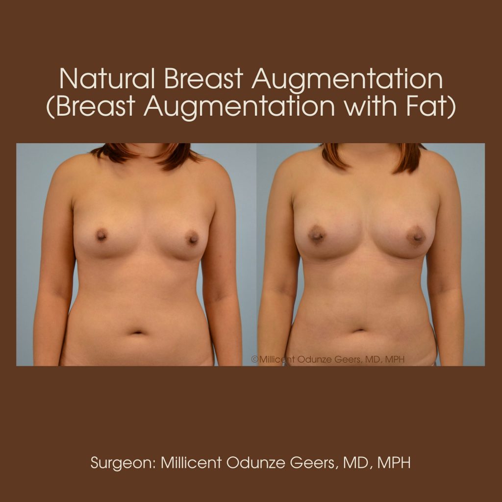 Natural Breast Augmentation - Flying Horse Medical Center - Dr. Millicent Odunze Geers