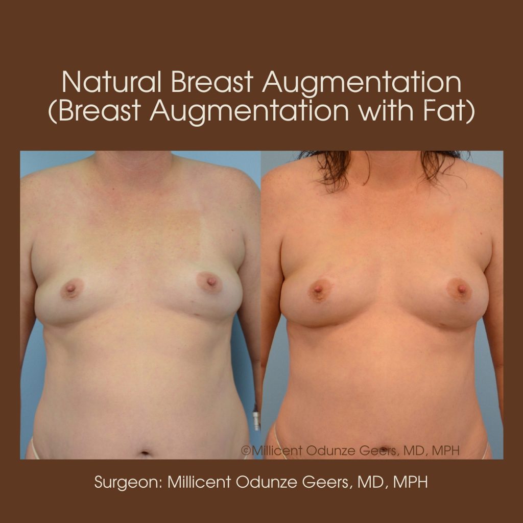 Natural Breast Augmentation - Flying Horse Medical Center - Dr. Millicent Odunze Geers