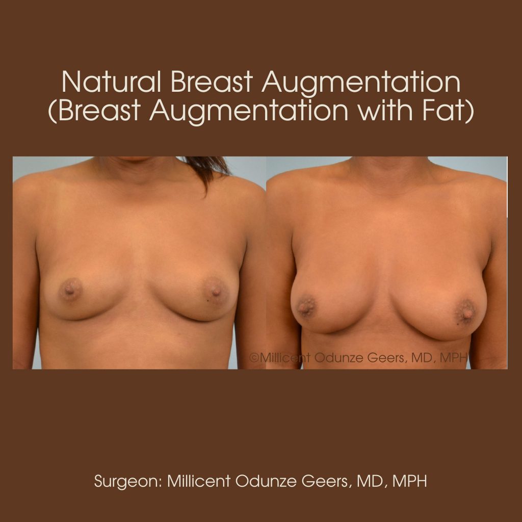 Best Colorado Springs Natural Breast Augmentation