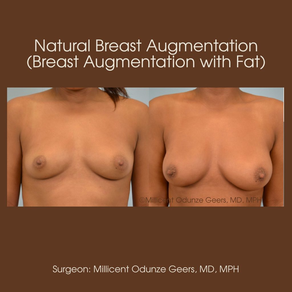Natural Breast Augmentation - Flying Horse Medical Center - Dr. Millicent Odunze Geers