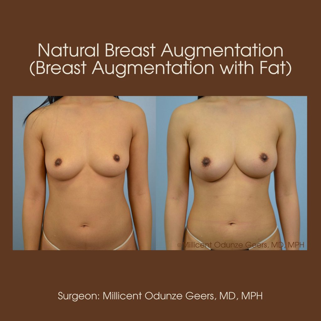 Natural Breast Augmentation - Flying Horse Medical Center - Dr. Millicent Odunze Geers