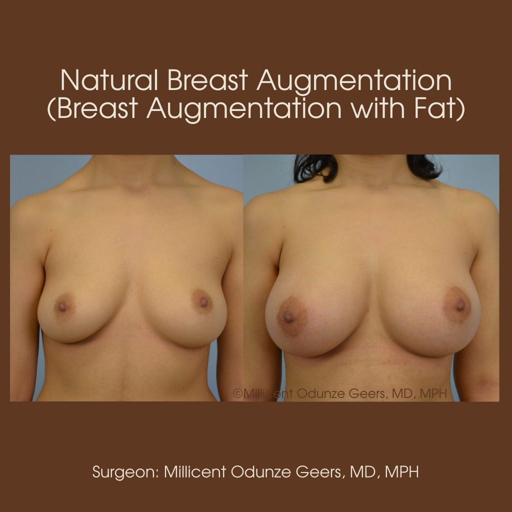 Natural Breast Augmentation - Flying Horse Medical Center - Dr. Millicent Odunze Geers