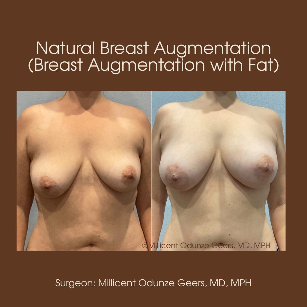 Natural Breast Augmentation - Flying Horse Medical Center - Dr. Millicent Odunze Geers