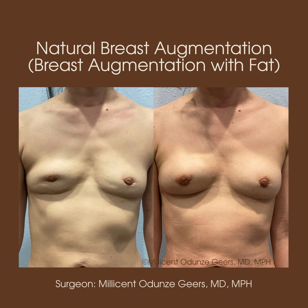 Natural Breast Augmentation - Flying Horse Medical Center - Dr. Millicent Odunze Geers