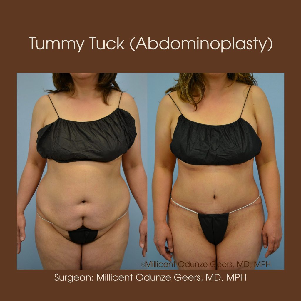 Tummy Tuck - Abdominoplasty -Flying Horse Medical Center - Dr. Millicent Odunze Geers