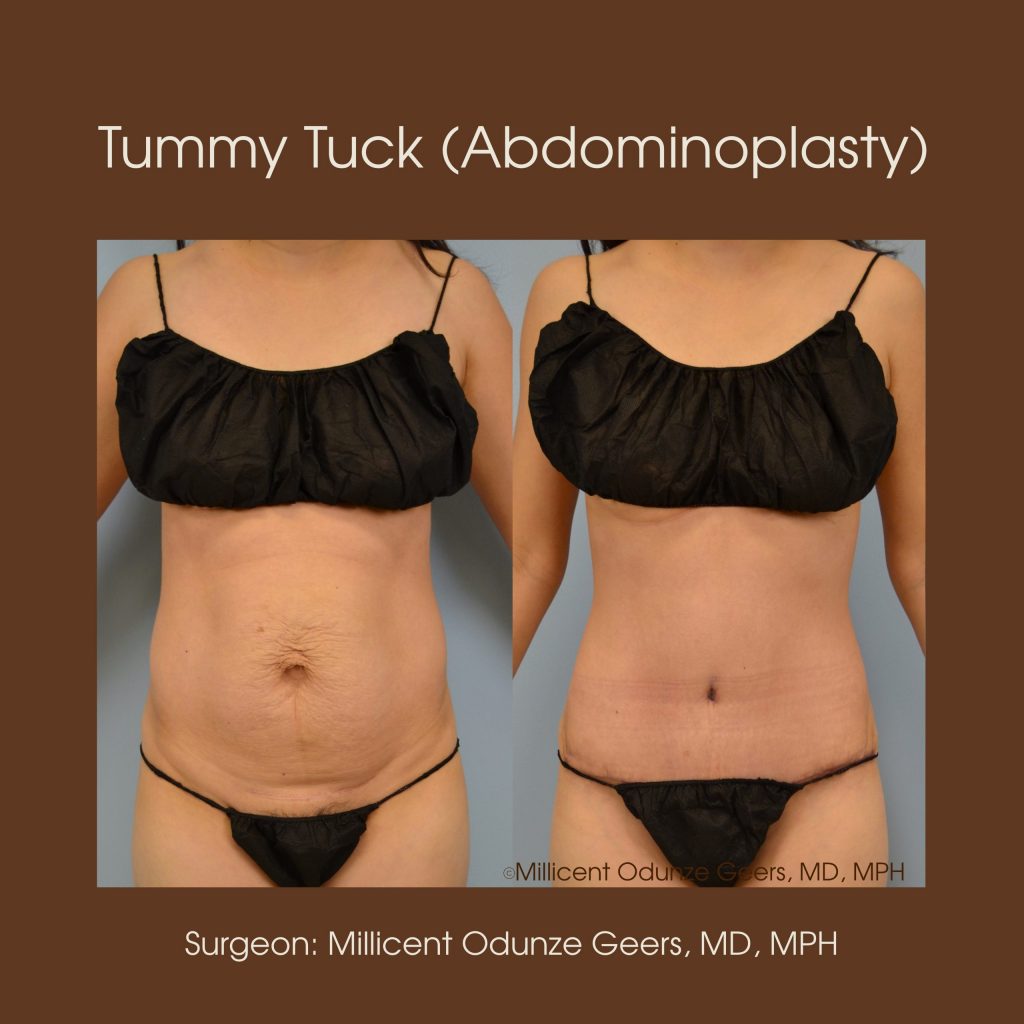 Tummy Tuck - Abdominoplasty -Flying Horse Medical Center - Dr. Millicent Odunze Geers