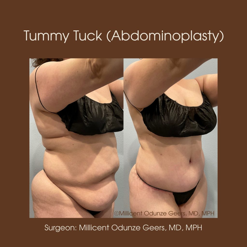 Tummy Tuck - Abdominoplasty -Flying Horse Medical Center - Dr. Millicent Odunze Geers