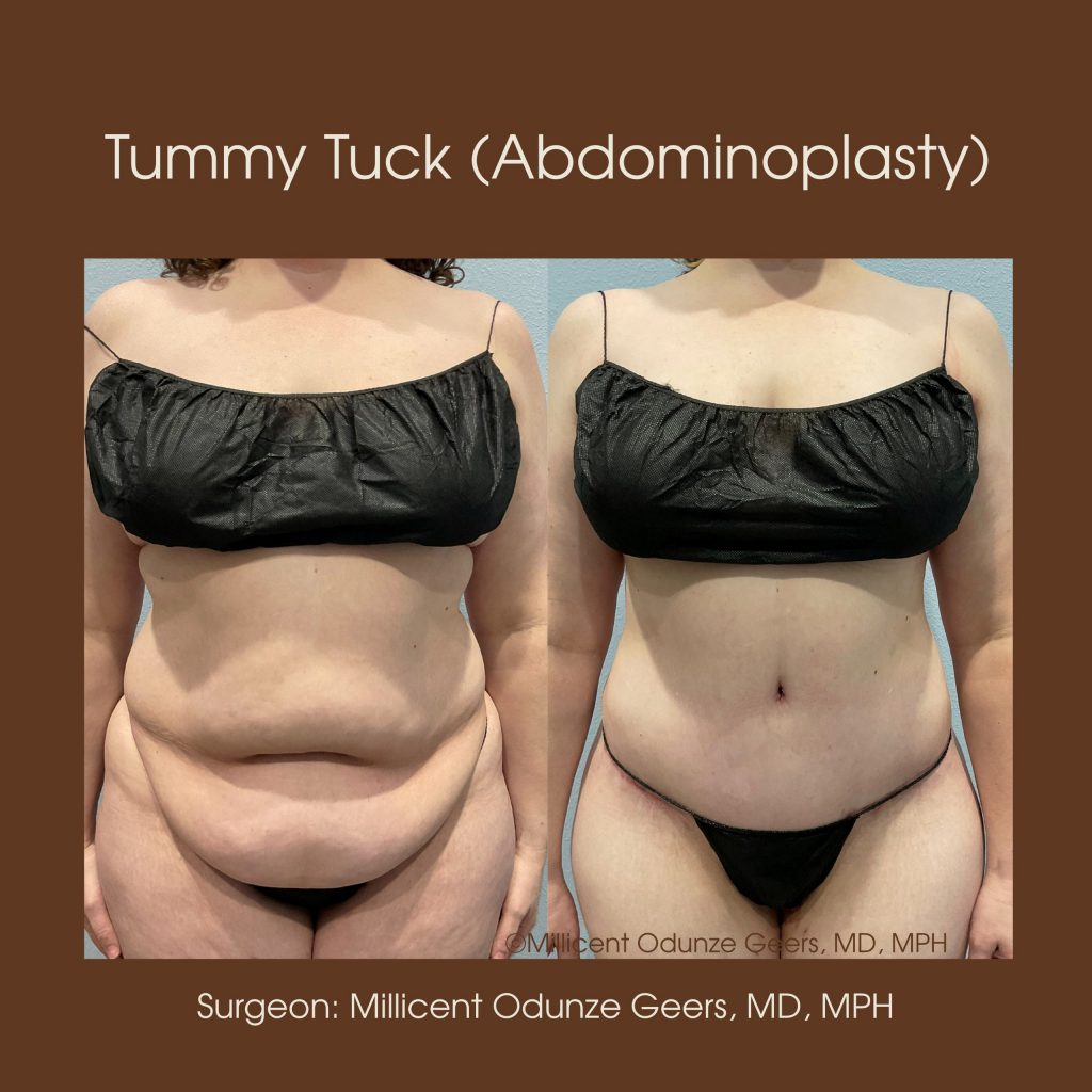 Tummy Tuck - Abdominoplasty -Flying Horse Medical Center - Dr. Millicent Odunze Geers