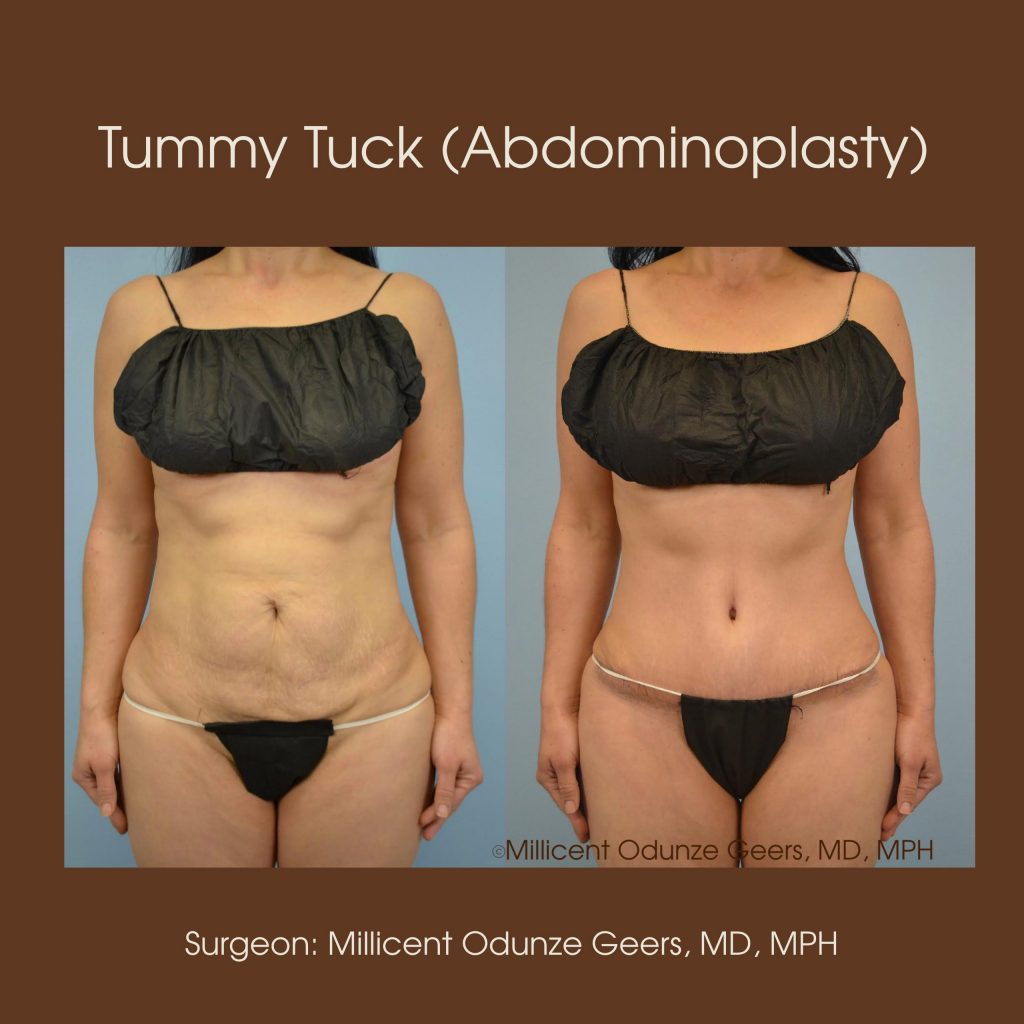 Tummy Tuck - Abdominoplasty -Flying Horse Medical Center - Dr. Millicent Odunze Geers