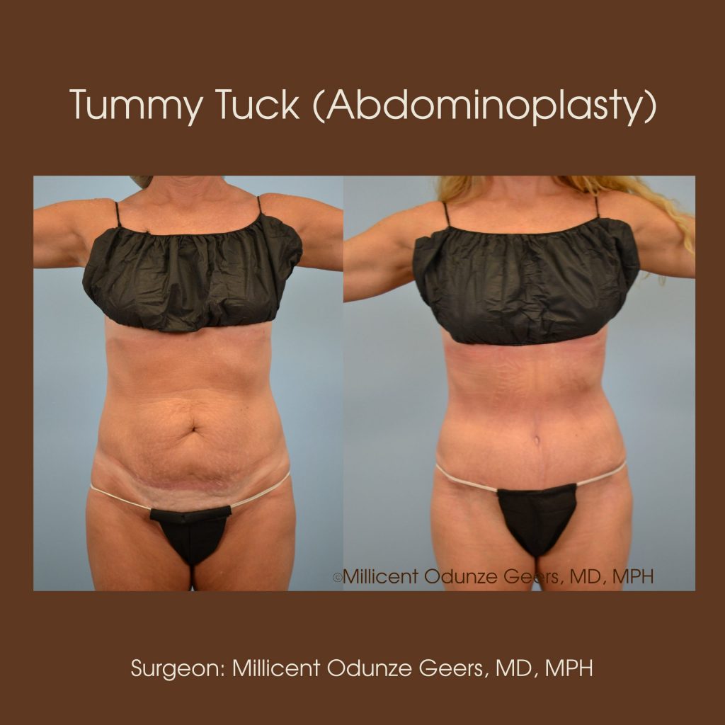 Tummy Tuck - Abdominoplasty -Flying Horse Medical Center - Dr. Millicent Odunze Geers