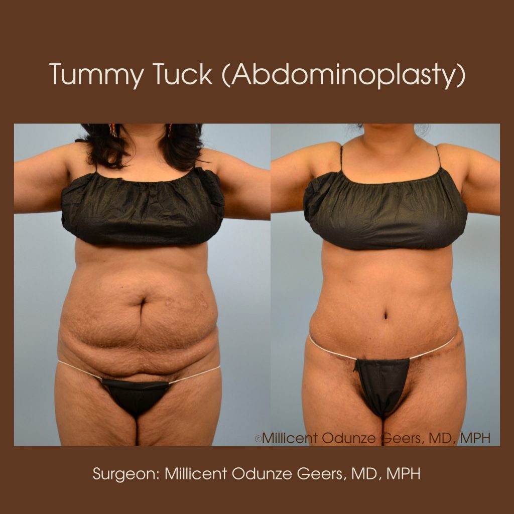 Tummy Tuck - Abdominoplasty -Flying Horse Medical Center - Dr. Millicent Odunze Geers