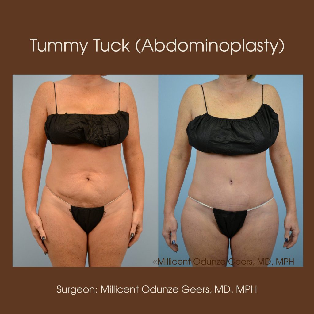 Tummy Tuck - Abdominoplasty -Flying Horse Medical Center - Dr. Millicent Odunze Geers