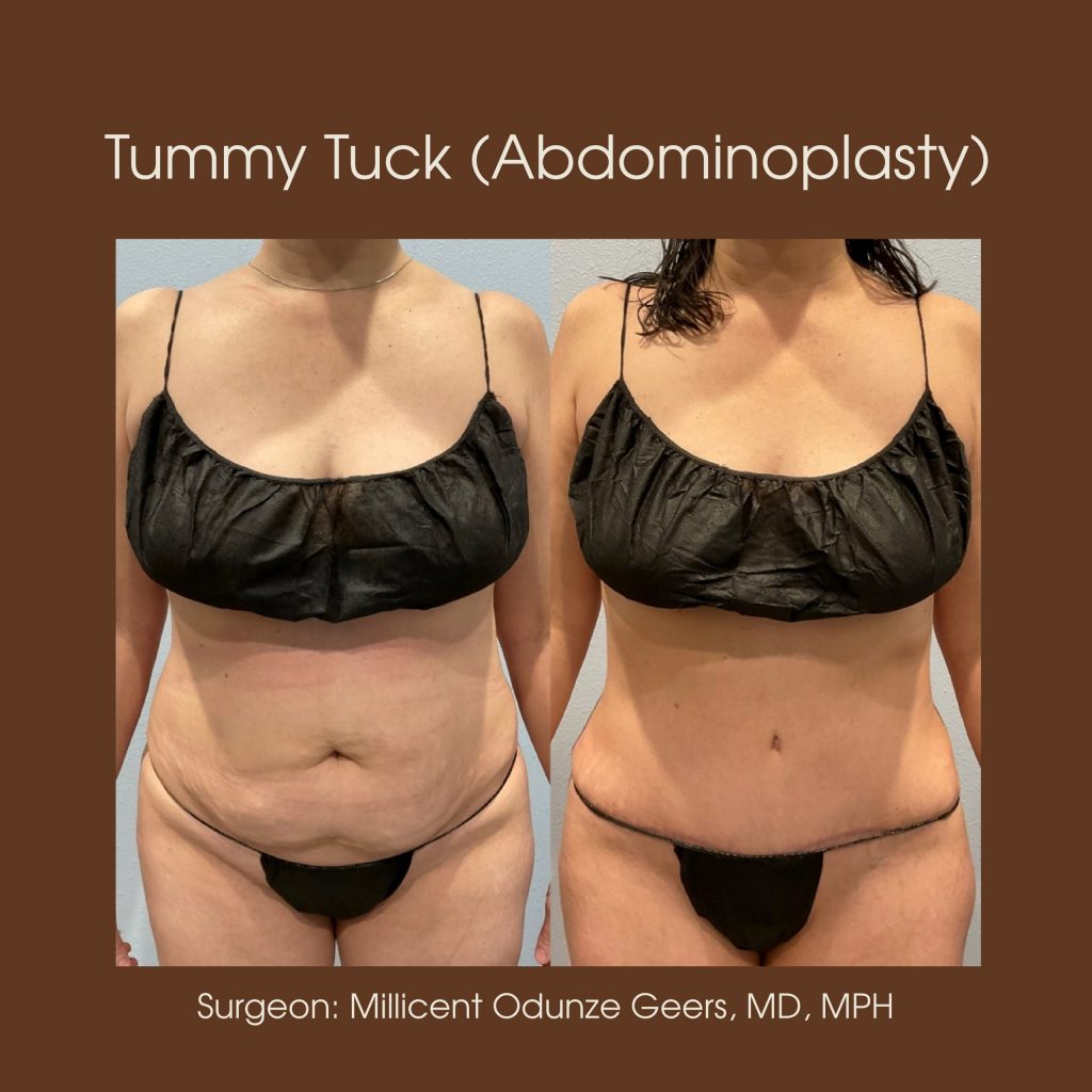 Tummy Tuck - Abdominoplasty -Flying Horse Medical Center - Dr. Millicent Odunze Geers