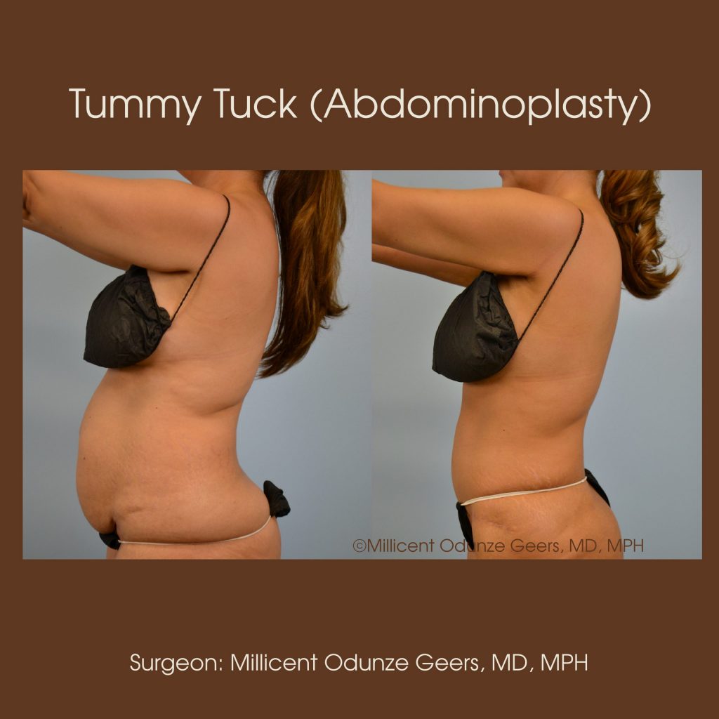 Tummy Tuck - Abdominoplasty -Flying Horse Medical Center - Dr. Millicent Odunze Geers