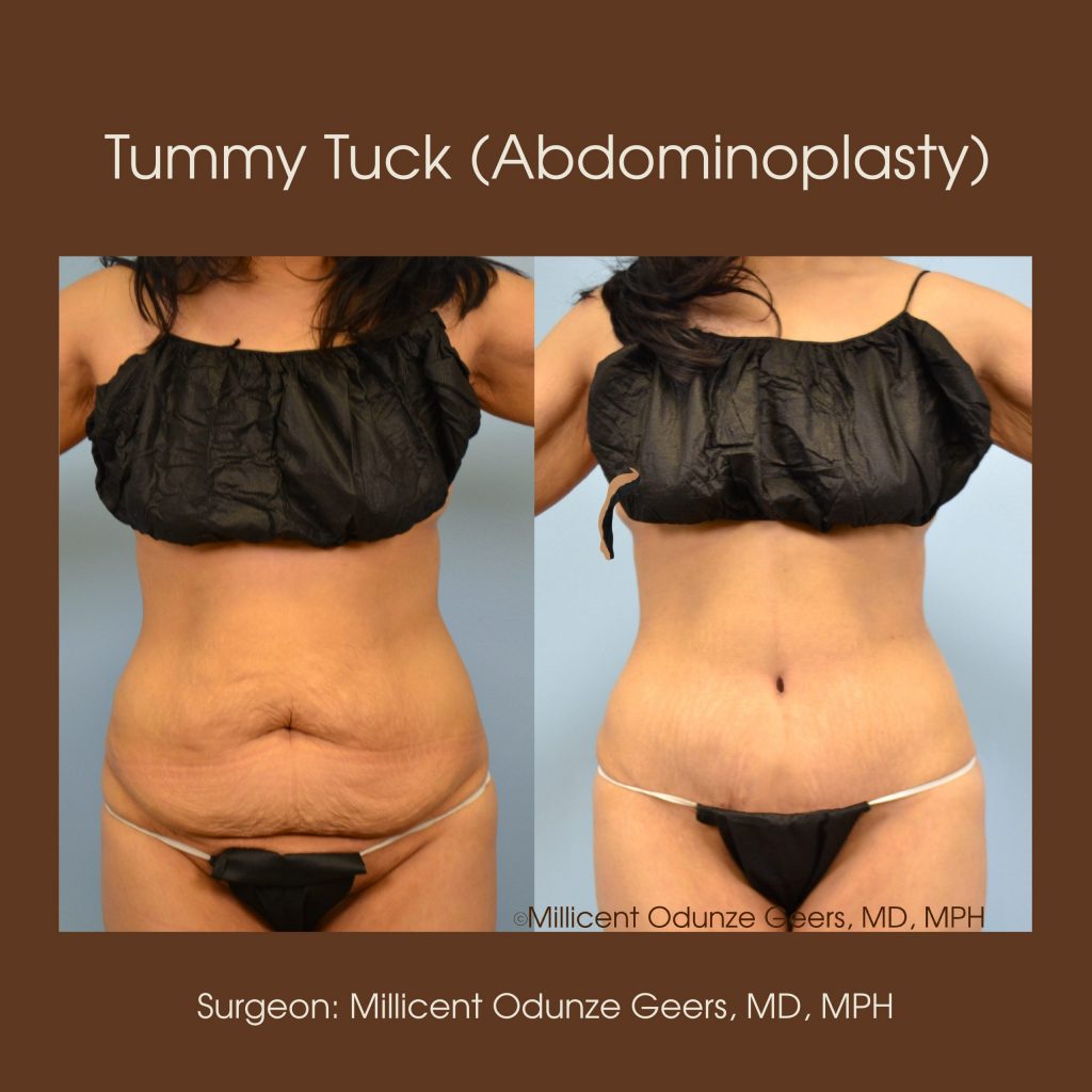 Tummy Tuck - Abdominoplasty -Flying Horse Medical Center - Dr. Millicent Odunze Geers