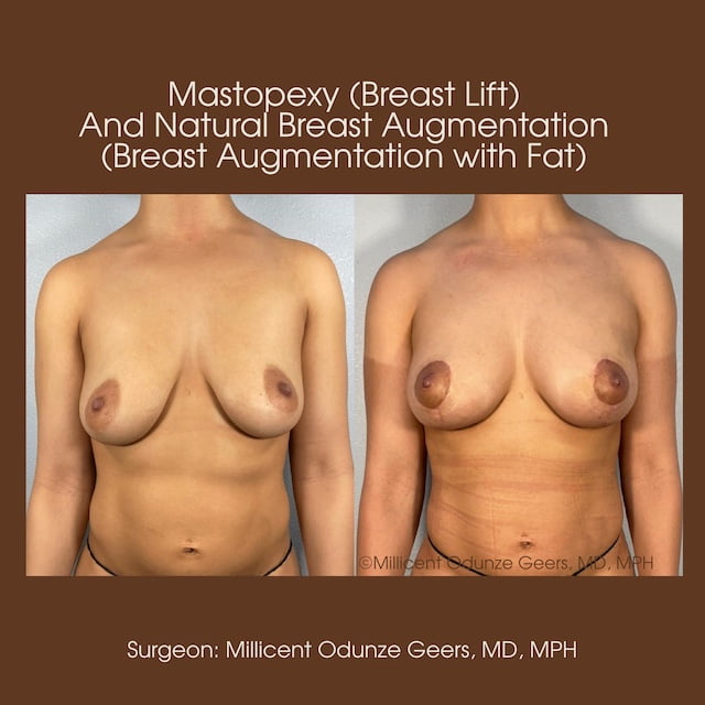 Breast Augumentation - Mastopexy - Plastic Surgery at Flying Horse Medical Center - Dr. Millicent Odunze Geers