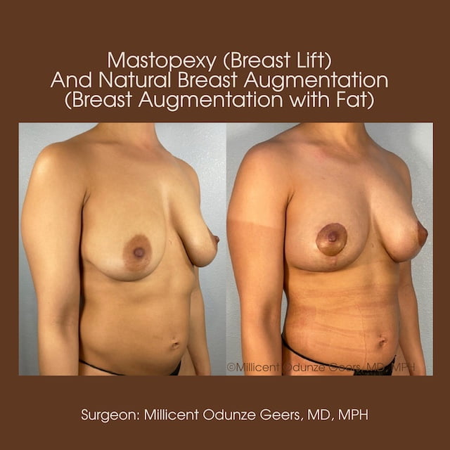 Breast Augumentation - Mastopexy - Plastic Surgery at Flying Horse Medical Center - Dr. Millicent Odunze Geers