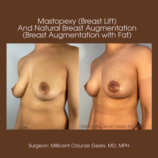 Breast Augumentation - Mastopexy - Plastic Surgery at Flying Horse Medical Center - Dr. Millicent Odunze Geers