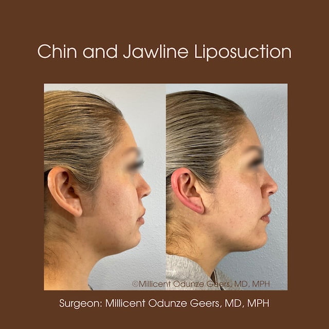 Chin and Jawline Liposuction - Plastic Surgery at Flying Horse Medical Center - Dr. Millicent Odunze Geers