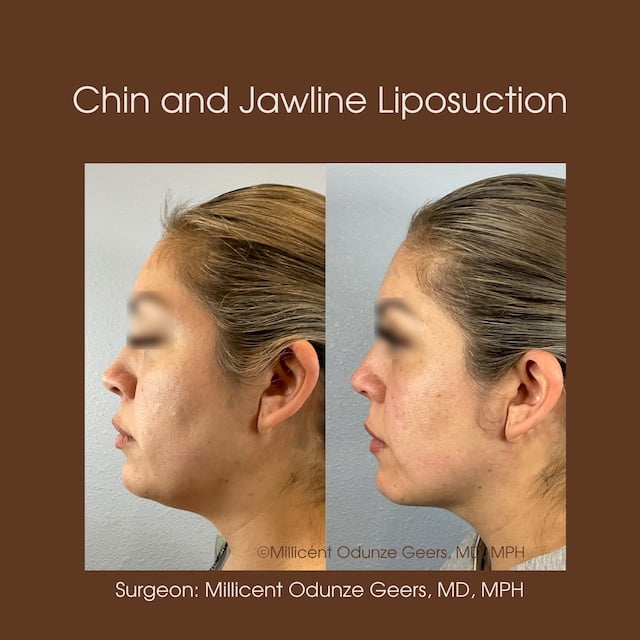 Chin and Jawline Liposuction - Plastic Surgery at Flying Horse Medical Center - Dr. Millicent Odunze Geers