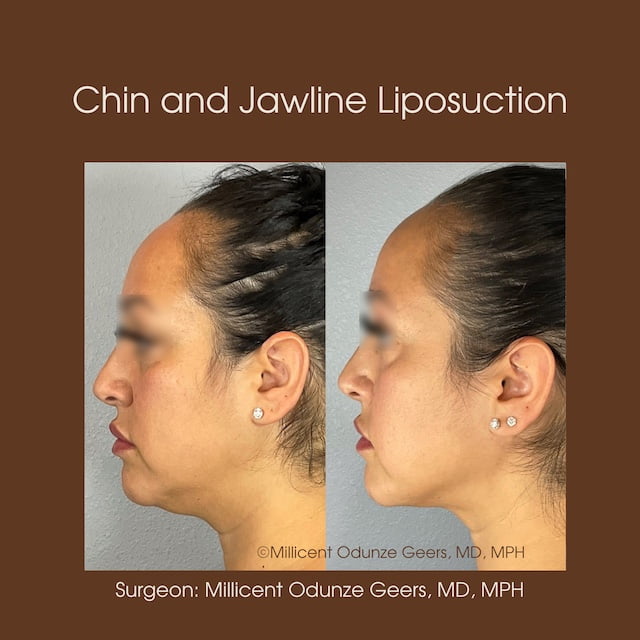 Chin and Jawline Liposuction - Plastic Surgery at Flying Horse Medical Center - Dr. Millicent Odunze Geers