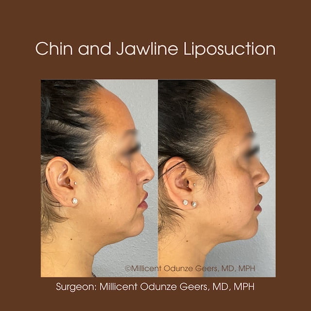 Chin and Jawline Liposuction - Plastic Surgery at Flying Horse Medical Center - Dr. Millicent Odunze Geers