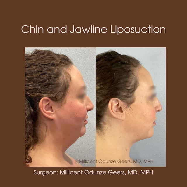 Chin and Jawline Liposuction - Plastic Surgery at Flying Horse Medical Center - Dr. Millicent Odunze Geers