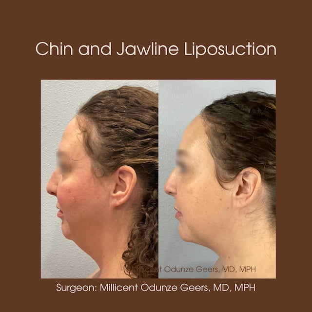 Chin and Jawline Liposuction - Plastic Surgery at Flying Horse Medical Center - Dr. Millicent Odunze Geers