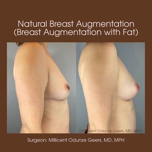 Breast Augumentation - Mastopexy - Plastic Surgery at Flying Horse Medical Center - Dr. Millicent Odunze Geers