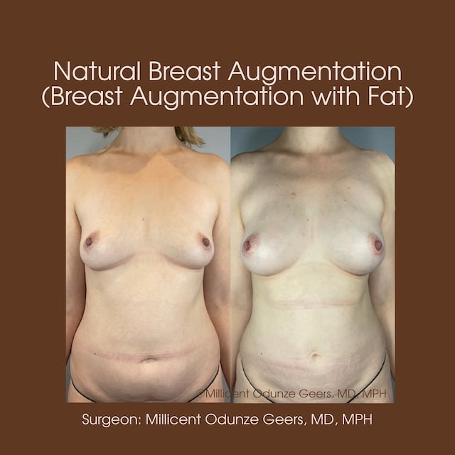 Breast Augumentation - Mastopexy - Plastic Surgery at Flying Horse Medical Center - Dr. Millicent Odunze Geers
