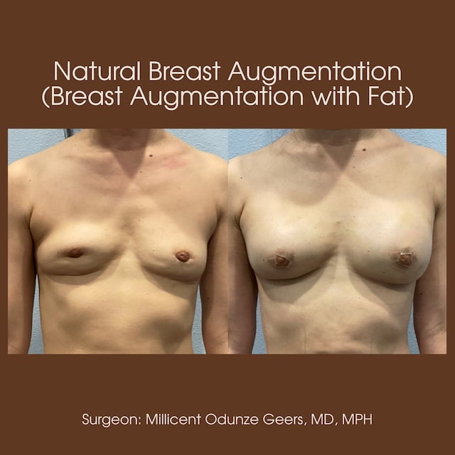 Breast Augumentation - Mastopexy - Plastic Surgery at Flying Horse Medical Center - Dr. Millicent Odunze Geers
