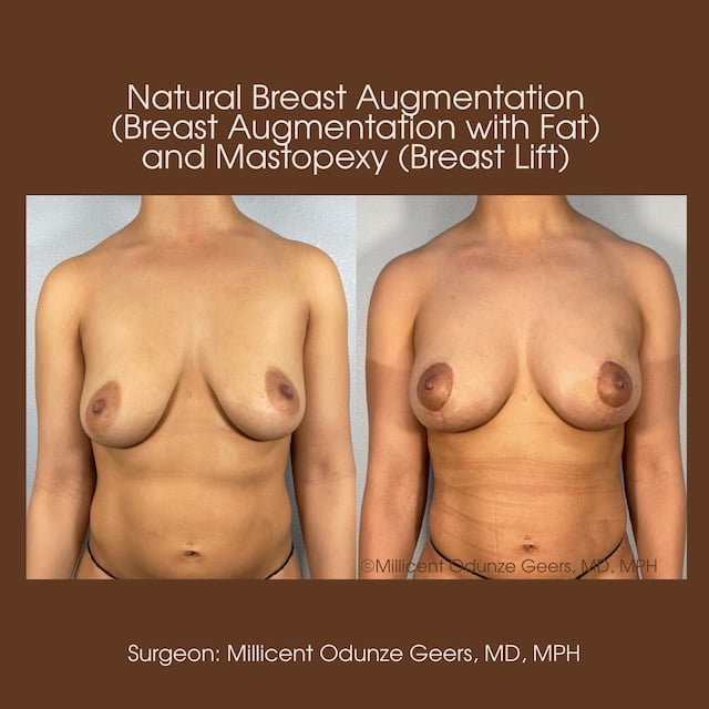 Breast Augumentation - Mastopexy - Plastic Surgery at Flying Horse Medical Center - Dr. Millicent Odunze Geers
