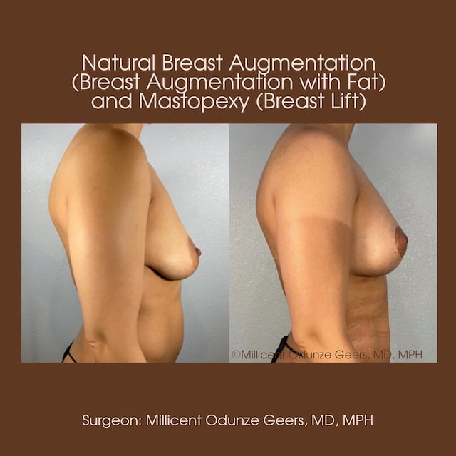 Breast Augumentation - Mastopexy - Plastic Surgery at Flying Horse Medical Center - Dr. Millicent Odunze Geers