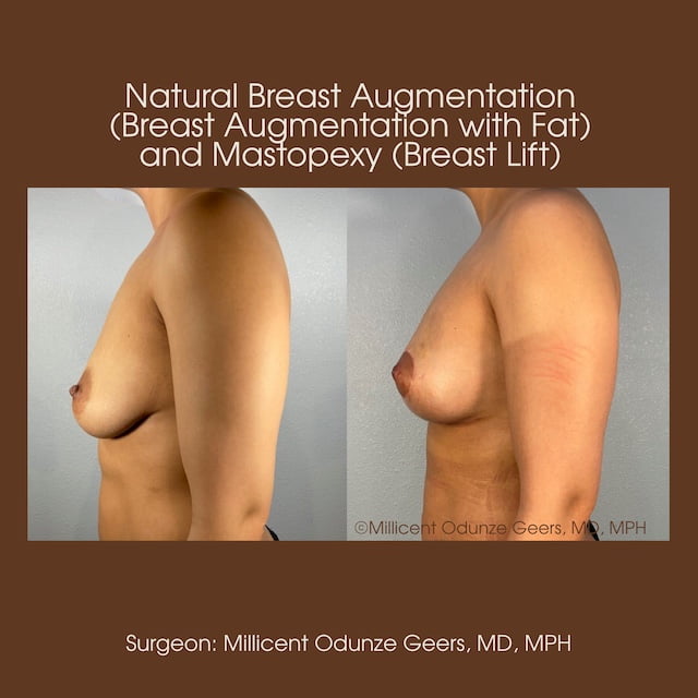 Breast Augumentation - Mastopexy - Plastic Surgery at Flying Horse Medical Center - Dr. Millicent Odunze Geers