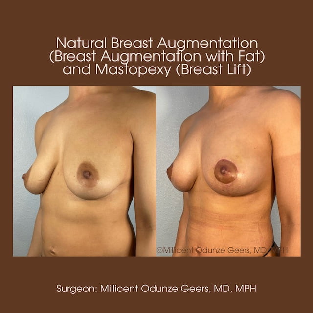 Breast Augumentation - Mastopexy - Plastic Surgery at Flying Horse Medical Center - Dr. Millicent Odunze Geers
