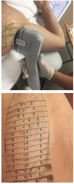 mira dry laser treatment in process